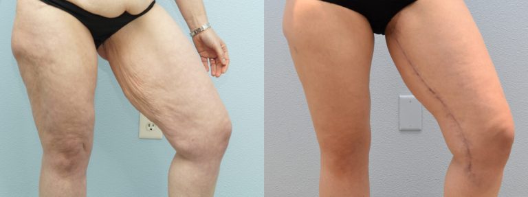 2-CM-Thigh-FrontLeft-scaled