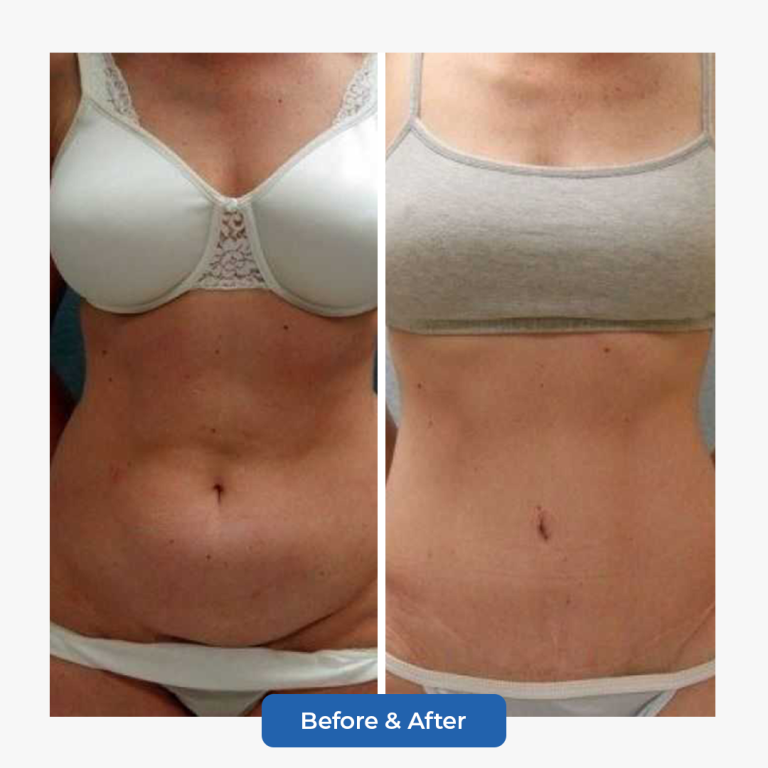Abdominoplasty-2.png adlı dosyanın kopyası