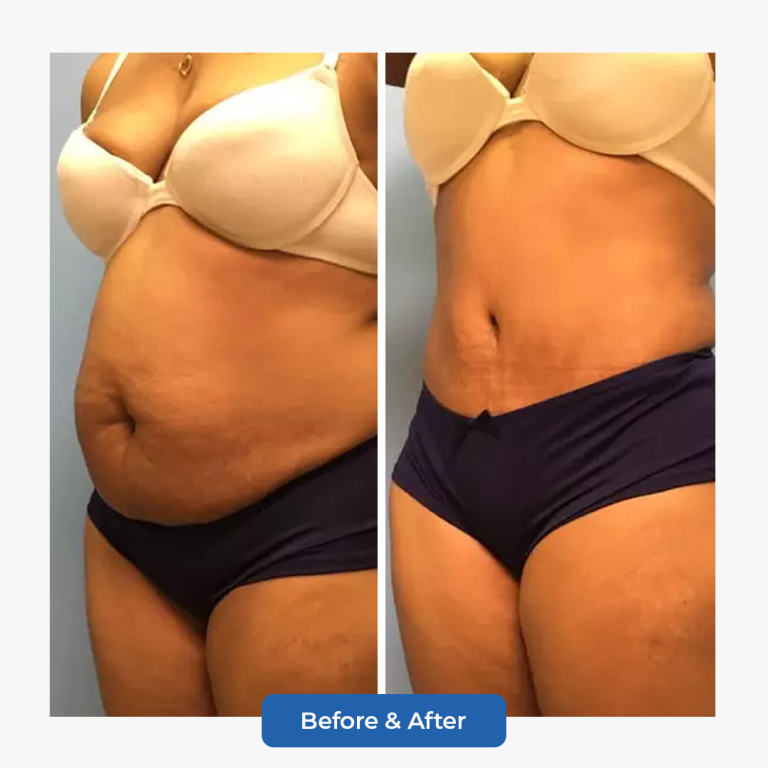 Abdominoplasty-3.png adlı dosyanın kopyası