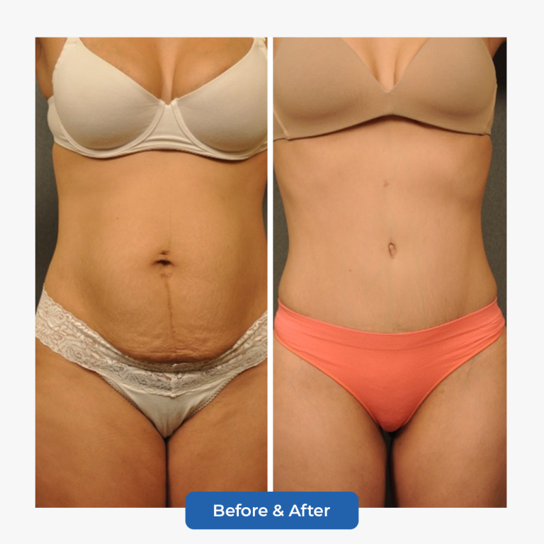 Abdominoplasty-4.png adlı dosyanın kopyası