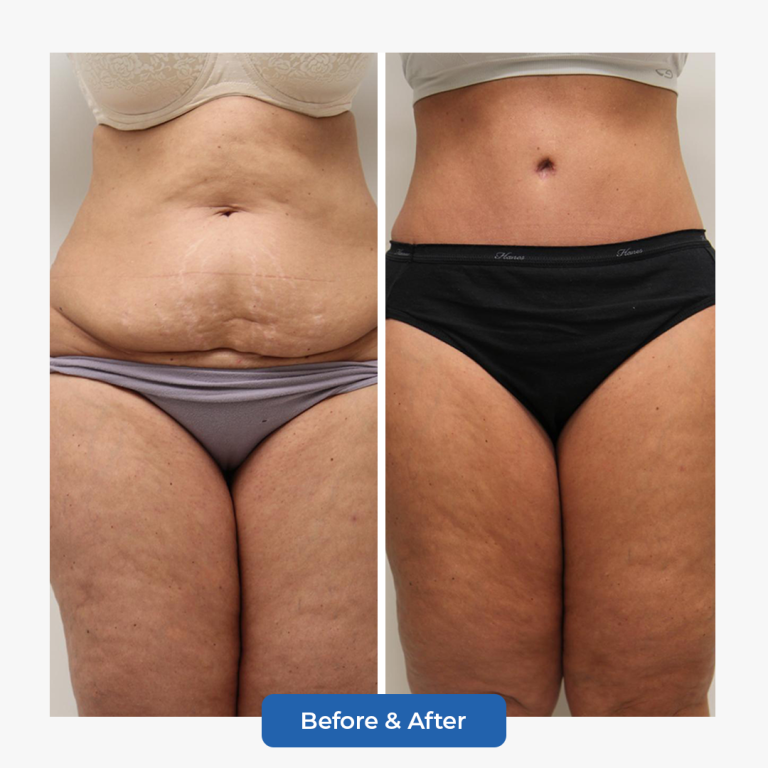 Abdominoplasty-5.png adlı dosyanın kopyası