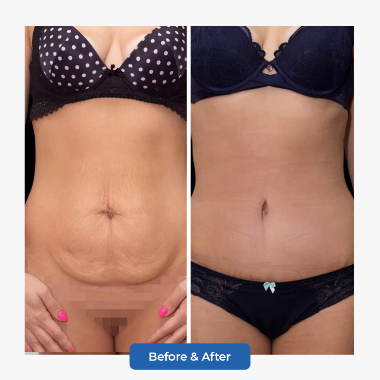 Abdominoplasty-6.png adlı dosyanın kopyası