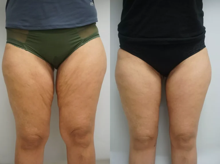thigh-lift-314-front-detail