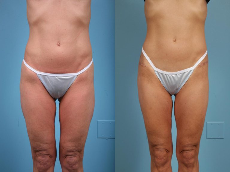 thigh-lift-43-view-1-detail