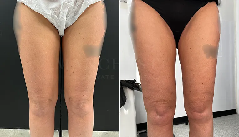 vaser-lipo-legs-before-and-after-patient-2