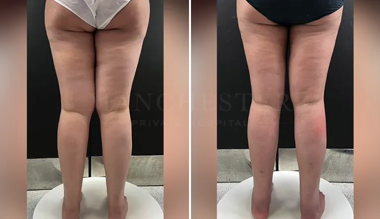 vaser-lipo-thighs-before-after-patient-2
